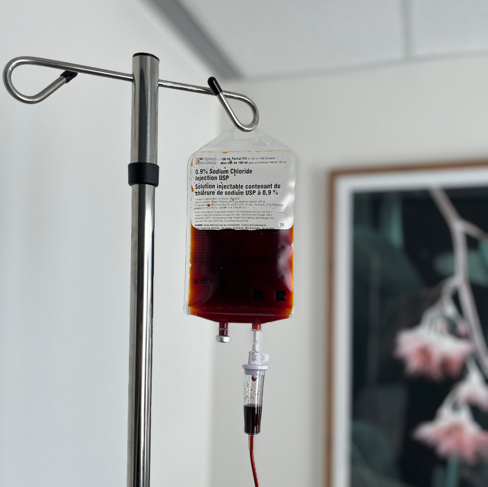 IV Iron Therapy for Anemia and Fatigue