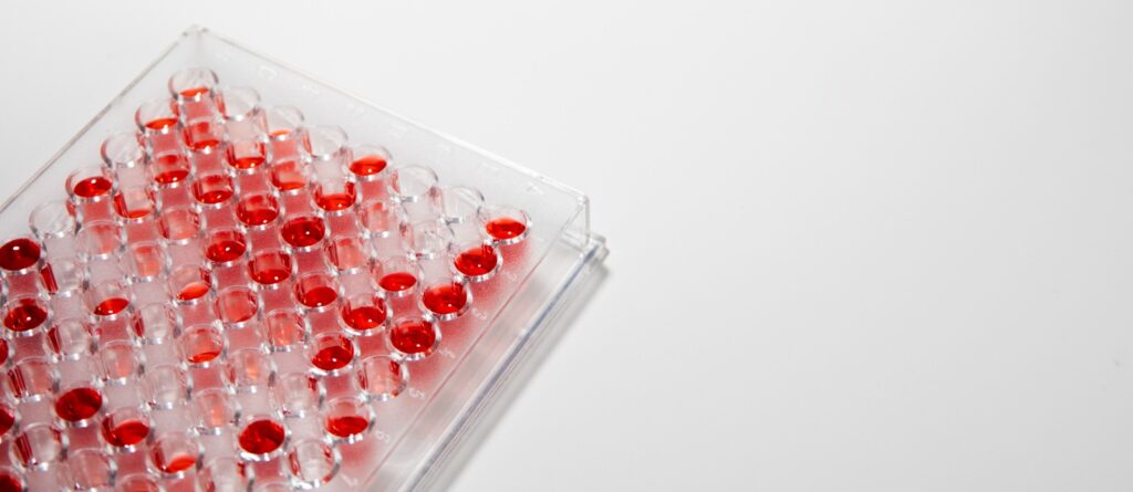 IV Iron Therapy for Anemia and Fatigue